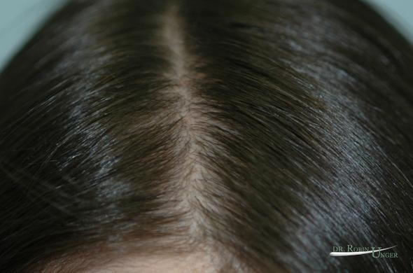 Young Woman With PCOS And Hair Loss Dr Robin Unger