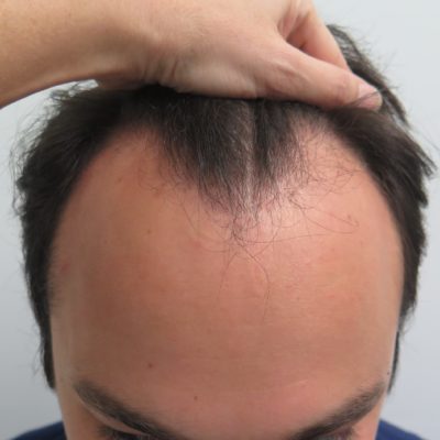Hair Transplant in 23 Year Old Male