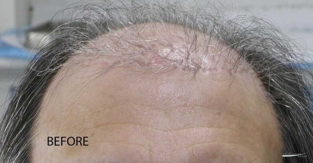 Before Hair Transplant Service NYC