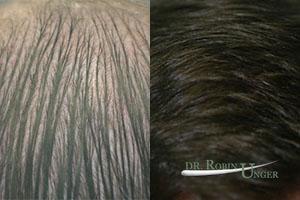 Before-surgery-after-one-surgery-to-the-front-and-one-to-the-midscalp