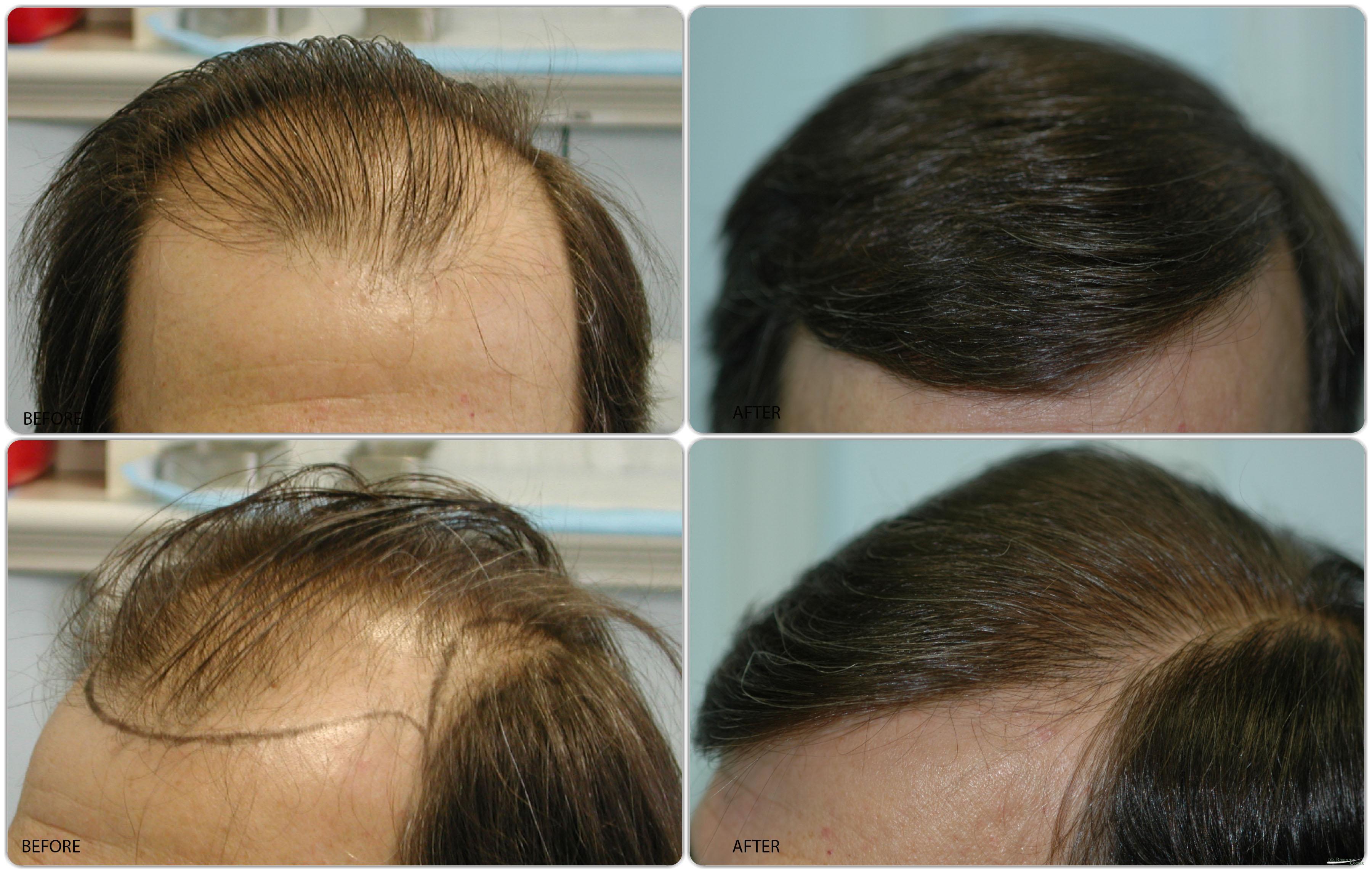 Treatment of a male with frontal hair loss | Dr. Unger | Dr. Robin Unger |  Hair Transplant Specialist