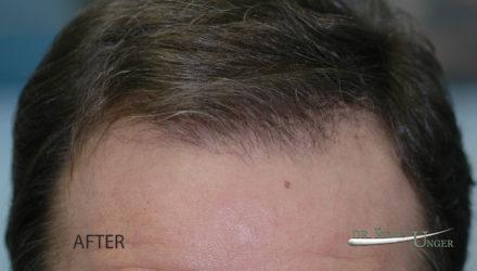 Male Hair Transplant With Earlier Growth Than Average