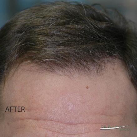Male Hair Transplant With Earlier Growth Than Average