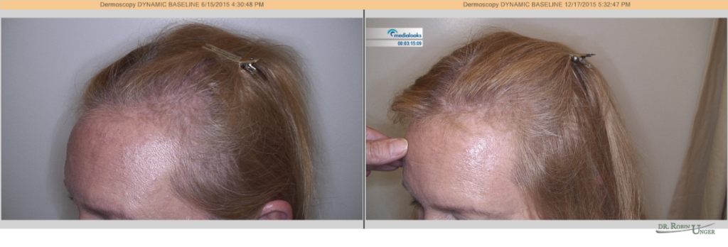 Female Pattern Hair Loss 2