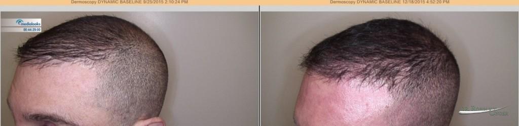 Male Pattern Hair Loss 2