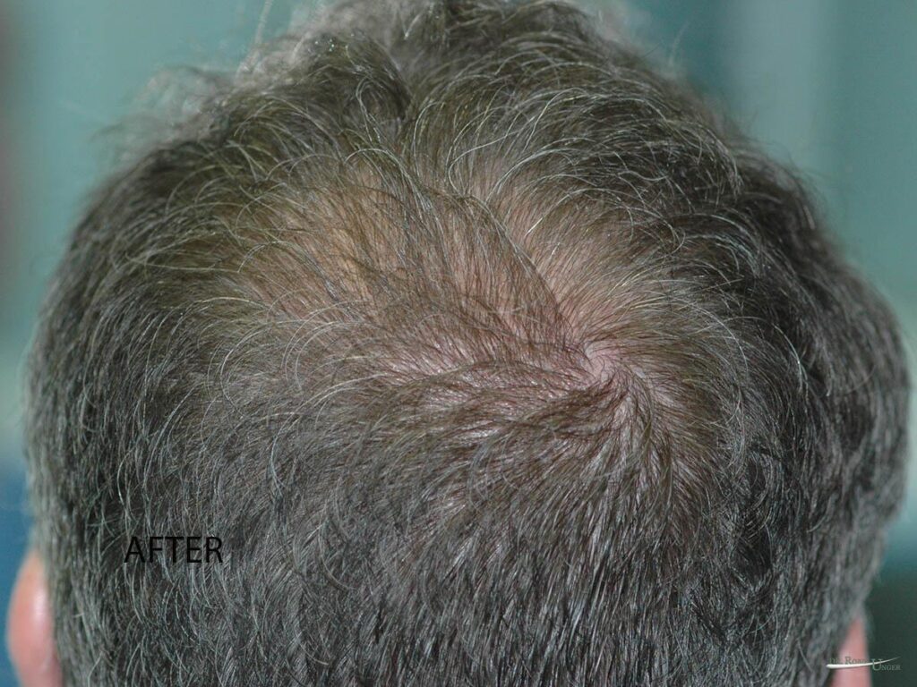 Hair Transplant Service Hair Loss Doctor NYC