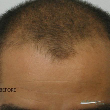 Hair transplant to the entire frontal region