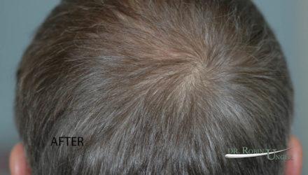 Multiple Hair Transplant Surgeries For 57 Year Old Male