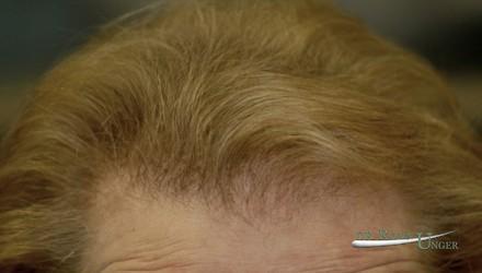 Severe female hair loss
