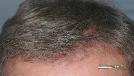 Hair transplant to refine hairline