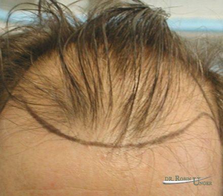 Treatment of a male with frontal hair loss