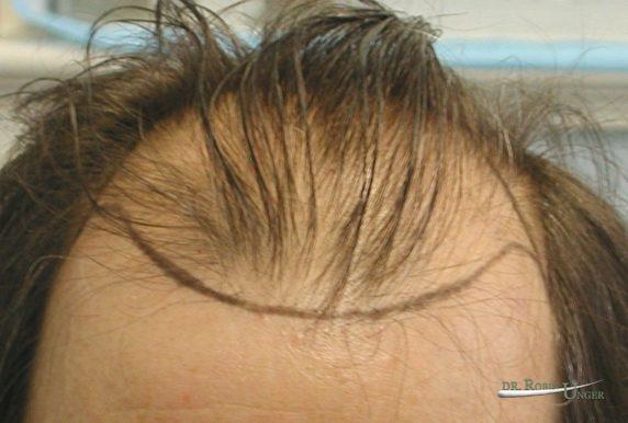 Treatment of a male with frontal hair loss