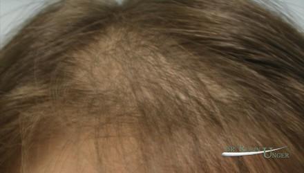 Young woman with PCOS and hair loss