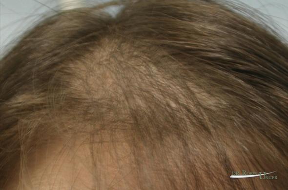 Young Woman With PCOS And Hair Loss Dr Robin Unger Dr Robin Unger 
