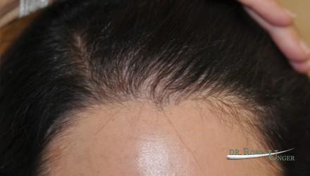 Young woman with hairloss, on spirinolactone and rogaine