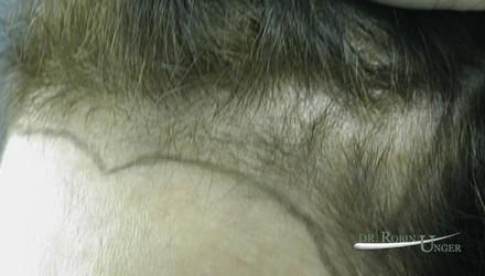 Women’s hair replacement surgery