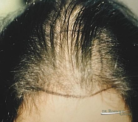 Hair transplant to area of female hair loss