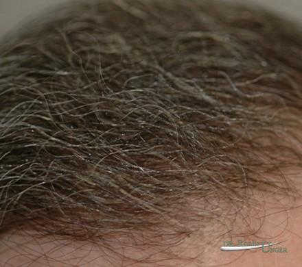 Subtle hair transplant surgery for men