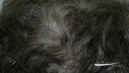 Treatment to hair thinning in the vertex