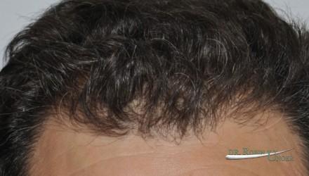 Male hair transplant surgery