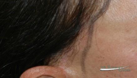 Hair transplant surgery to correct facelift scar