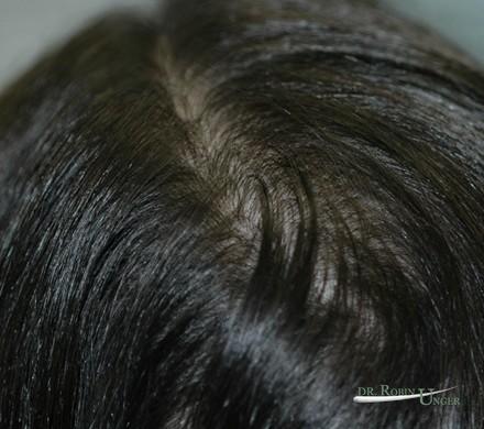 Female Hair Loss