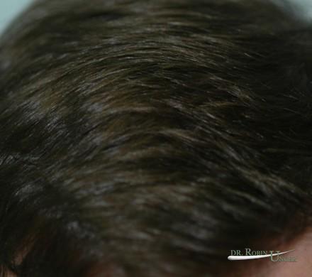Hair transplant in pre-existing hair