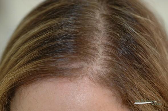 Female Hair Transplant Repair - 53 Years Old | Dr. Unger | Dr. Robin Unger  | Hair Transplant Specialist
