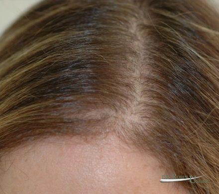 Female repair hair transplant surgery