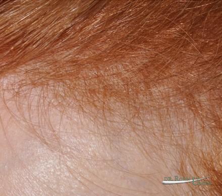 Frontal hair loss in woman