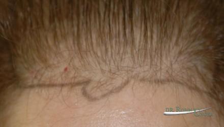 Women’s hair transplant and correction of scar