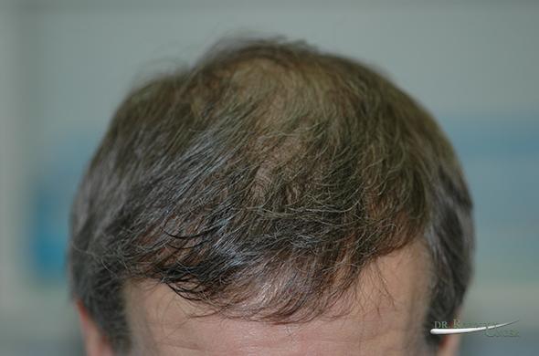 pic-1b-RK-10-mths-after-1st-HT-of-2379-FU-before-surgery-to-treat-midscalp