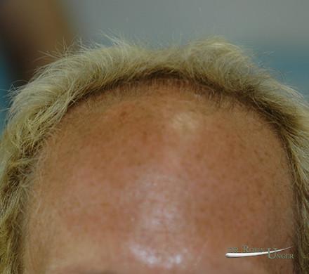 Hair Transplant in 45 Year Old Male