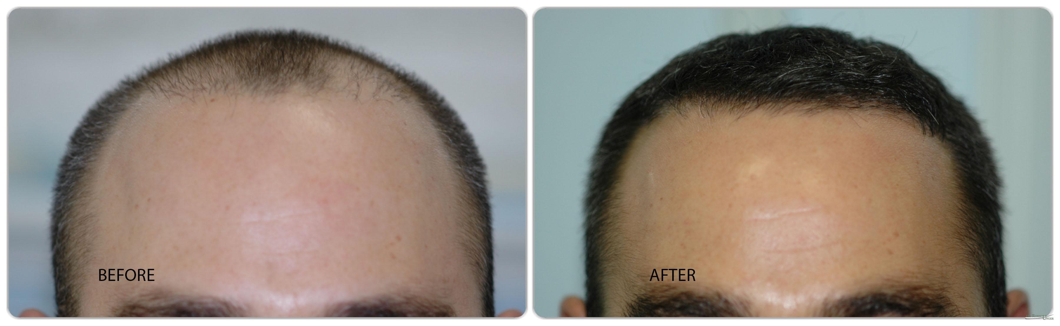 Male Hair Transplant for 36 Year Old | Dr. Robin Unger | Dr. Robin Unger | Hair  Transplant Specialist