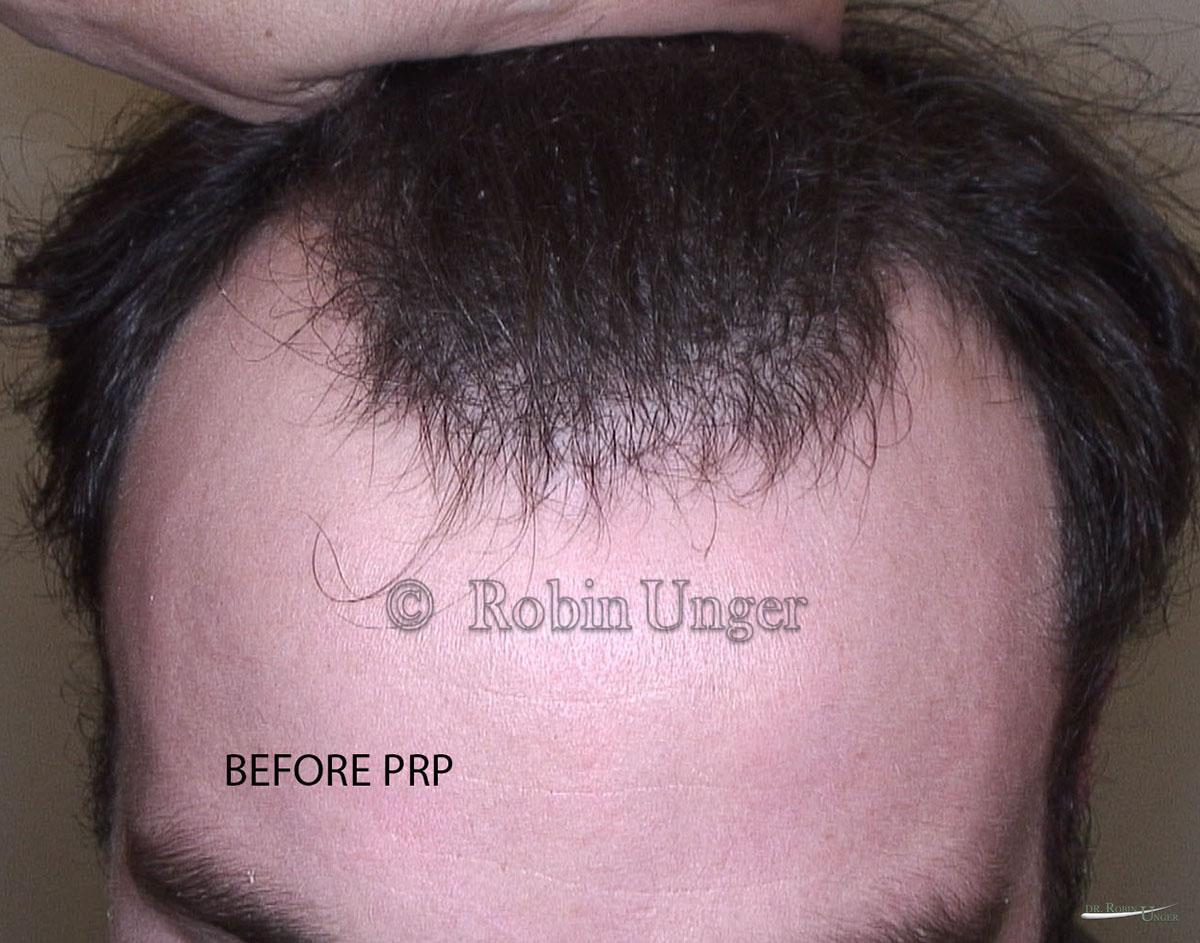 Everything You Should Know About Hair PRP Treatment  Aesthetics By DrJyoti