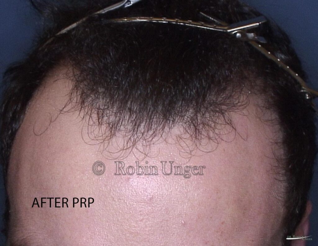 After PRP Treatment Hair Loss Doctor NYC