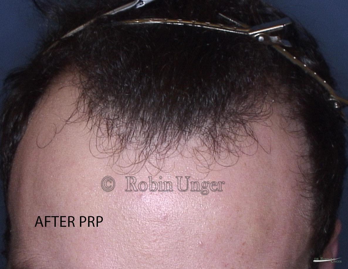 PRP on 21 year old male | Dr. Robin Unger | Hair Transplant Specialist