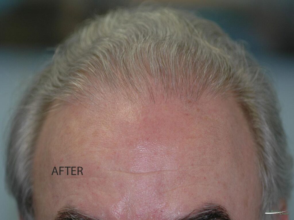 After Hair Transplant Service Hair Loss Doctor NYC