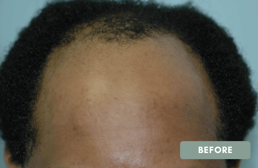 1 before Hair Transplant in 34 Year Old Male