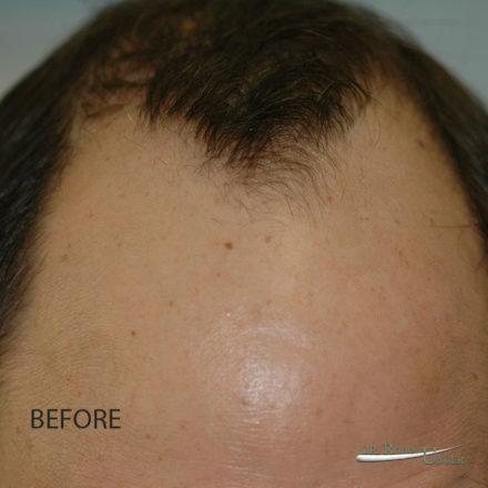 61 Year Old Male With Previously Transplanted Hair By Another Doctor