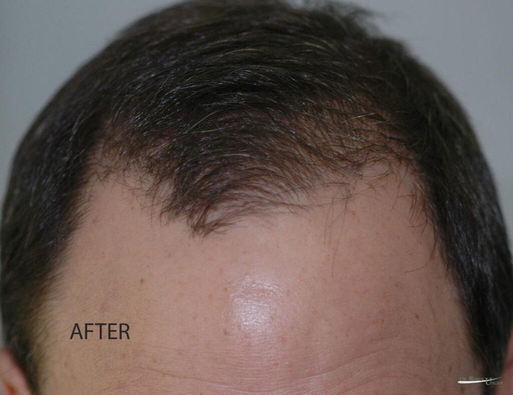 After Hair Transplant Service Hair Loss Doctor NYC