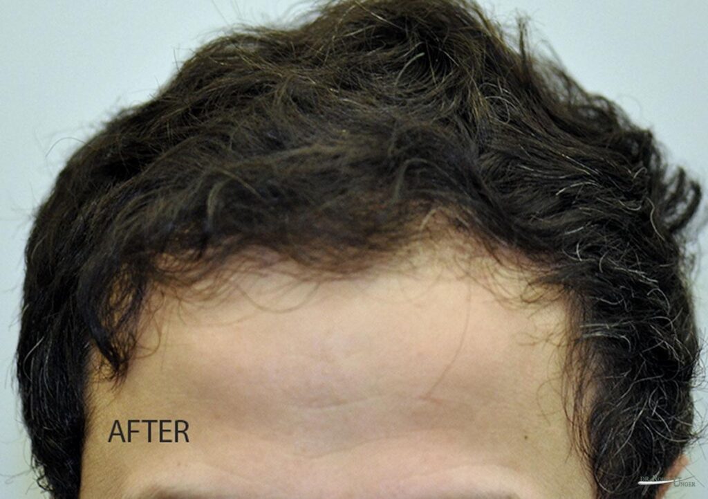 Hair Treatment for Hair Loss Doctor NYC