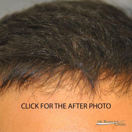 Hair transplant to the front