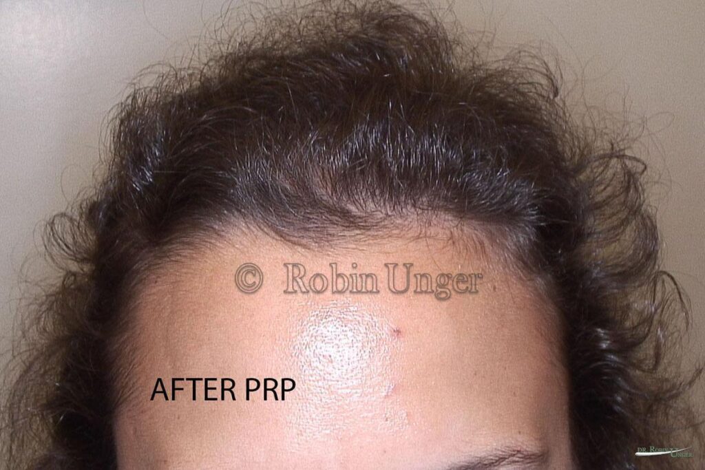 After PRP Treatment Hair Loss Doctor NYC