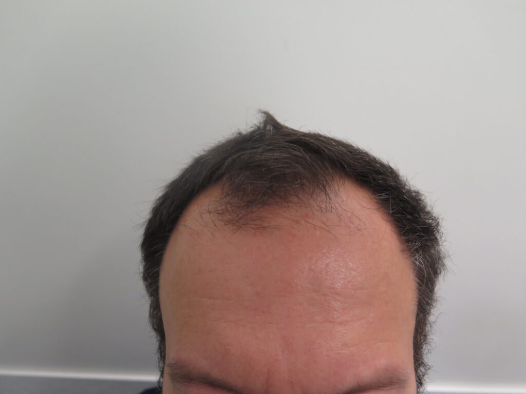 Hair Transplant in 52 Year Old Male