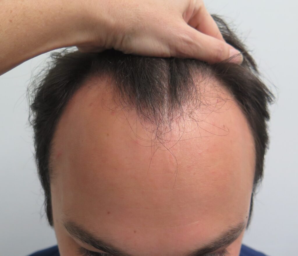 Hair Transplant in 23 Year Old Male