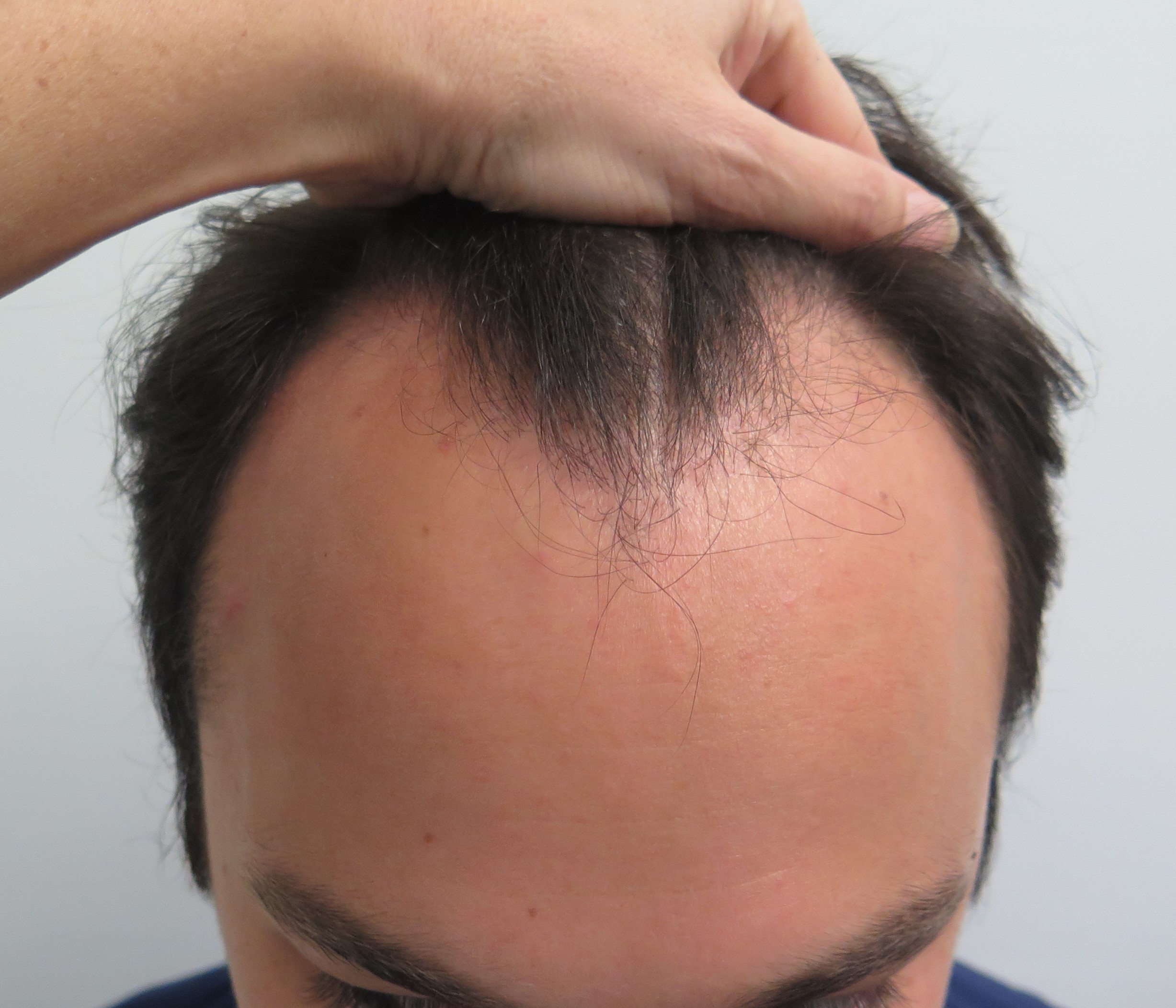 Hair Transplant in 23 Year Old Male | Dr. Robin Unger | Hair Transplant  Specialist