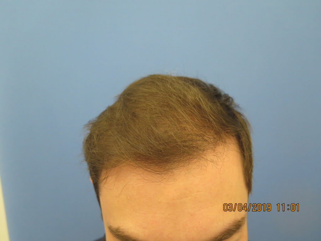 24 Year Old Male Minoxidil & Nutrafol Treatment