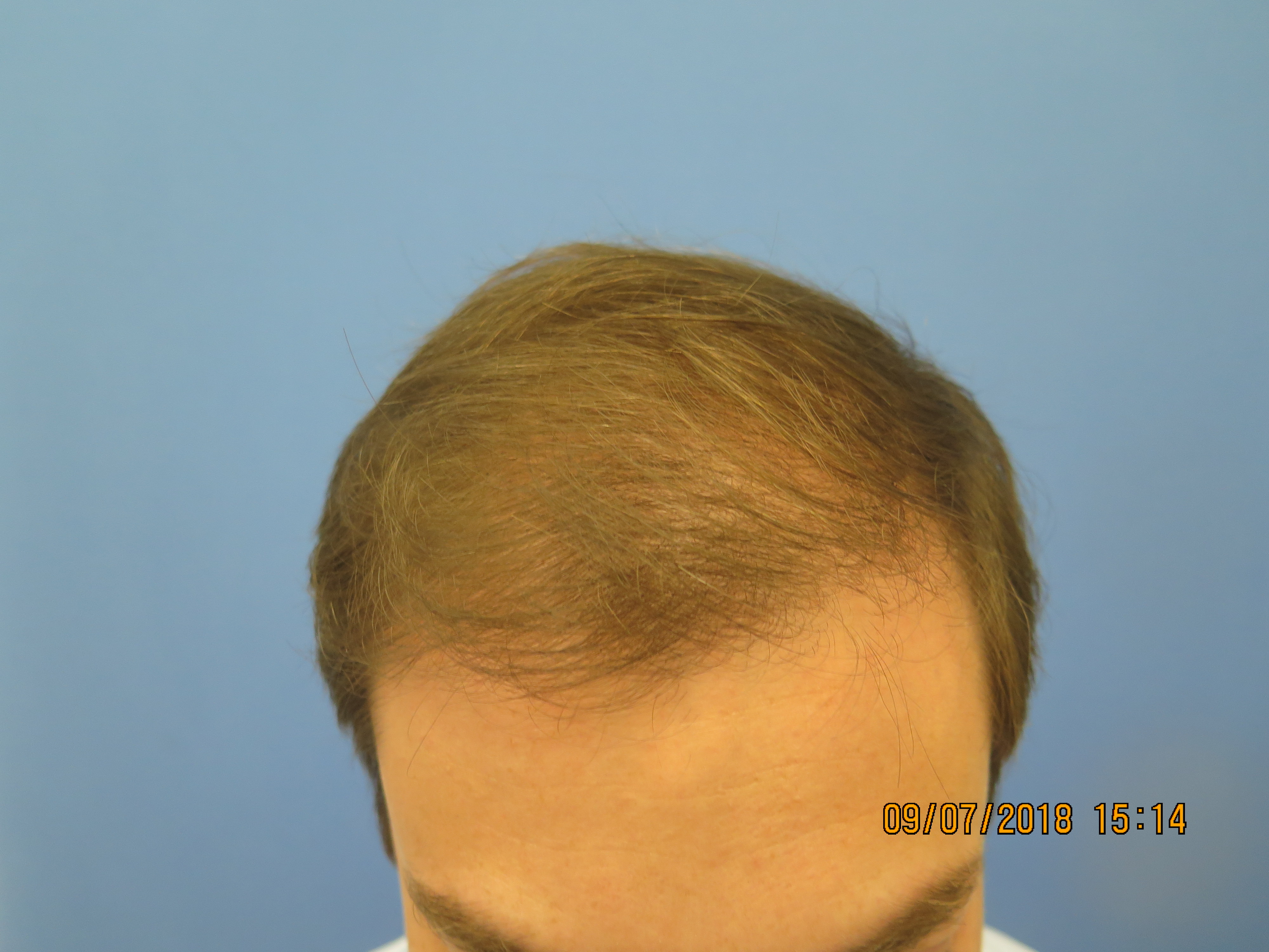 Conservative Hairline Recreation in a Young Adult Male  American Board of  Hair Restoration Society