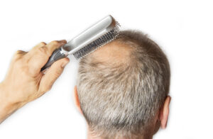 Alma TED hair regrowth NYC - Bald man with comb. Hair Loss concept